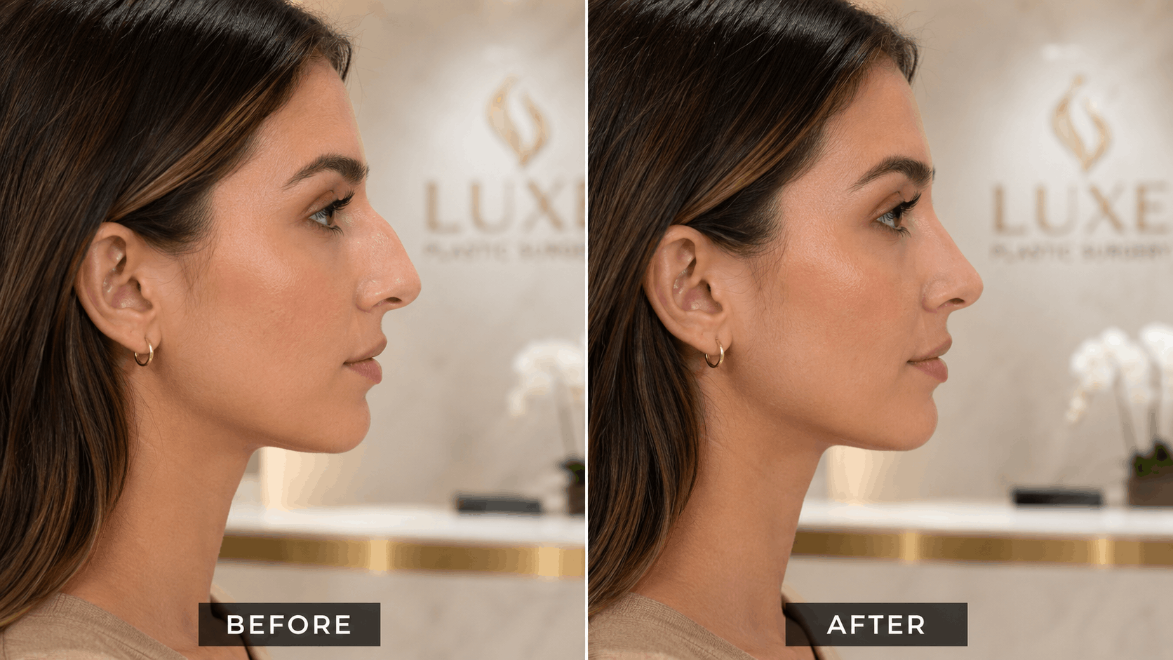Rinoplastia ultrasónica
