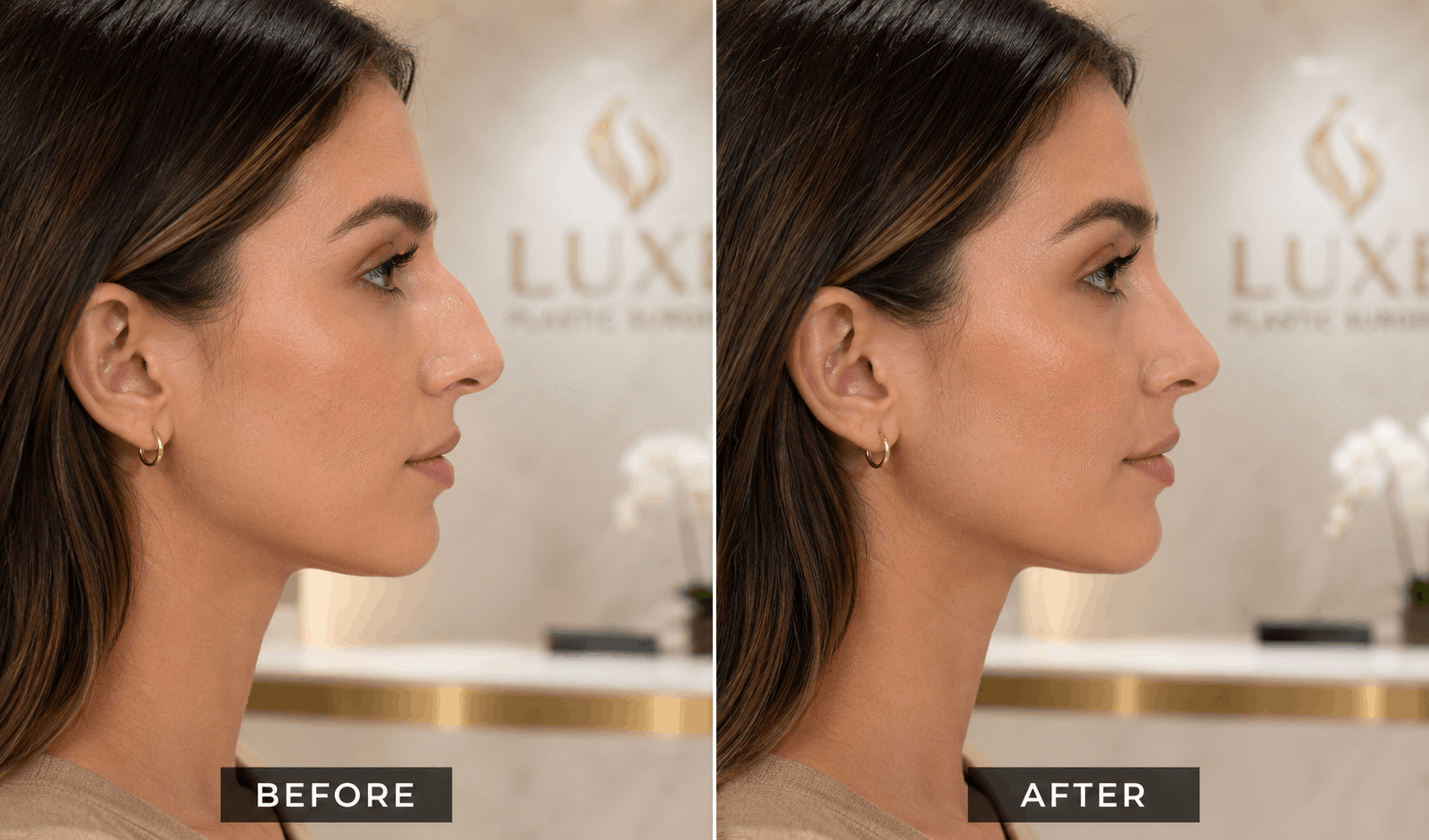 Rinoplastia Ultrasónica en Cali: Precio, Técnica y Resultados Reales