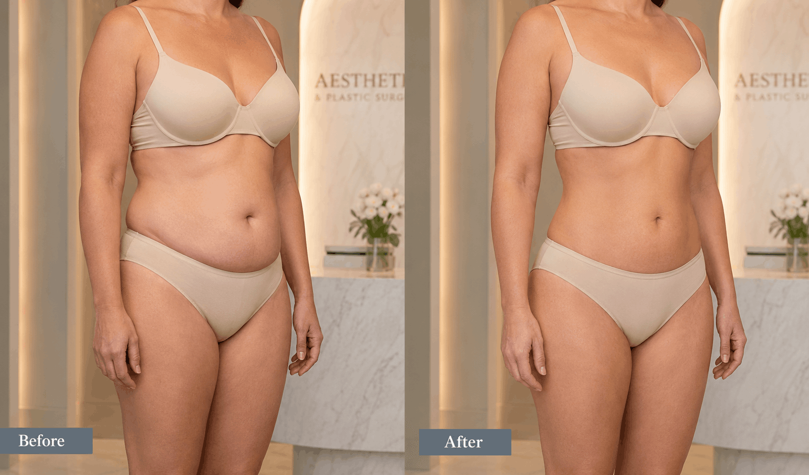 Abdominoplastia en Cali: Tipos, Candidatos y Recuperación (Precio COP)